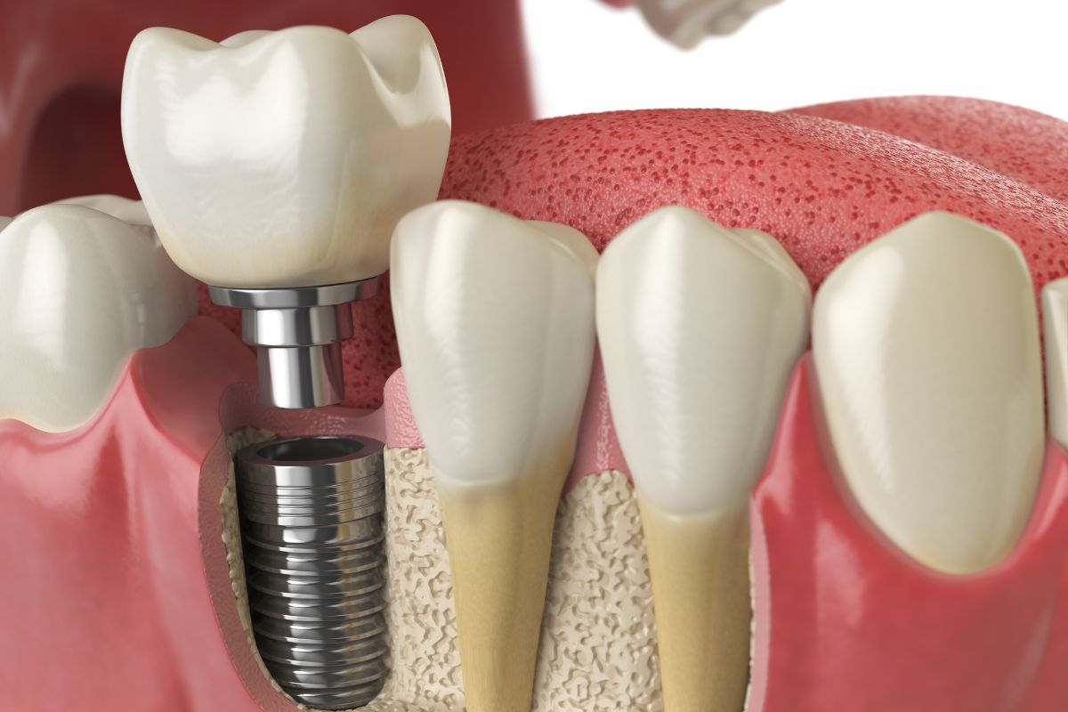 dental implants
