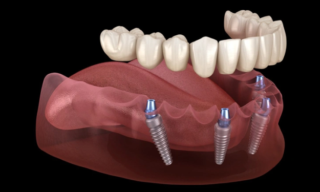All-on-4 Implants