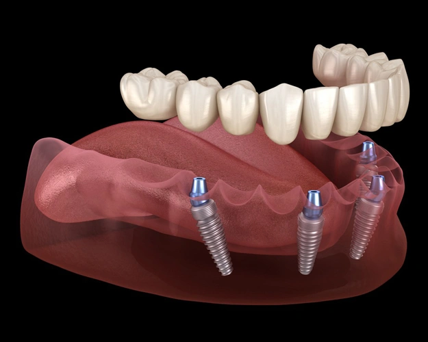 All-on-4 implants houston, louetta