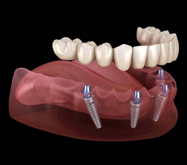 All-on-4 Dental Implants