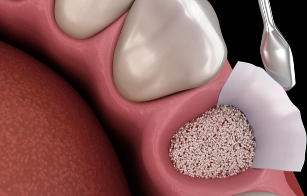 Bone Grafting