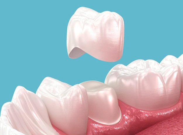 Dental Crown