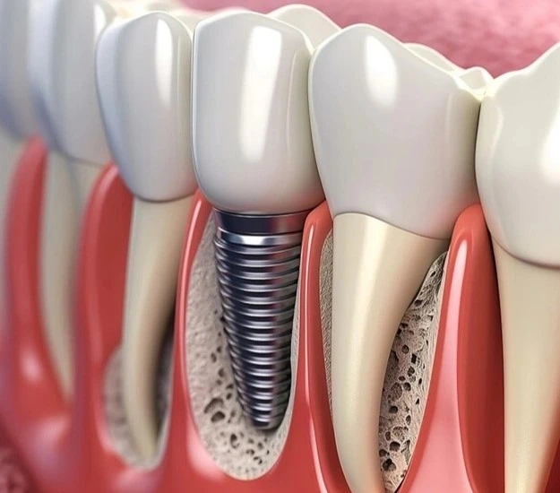dental implants katy