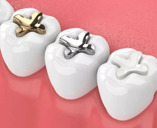 Dental Fillings Houston- Louetta