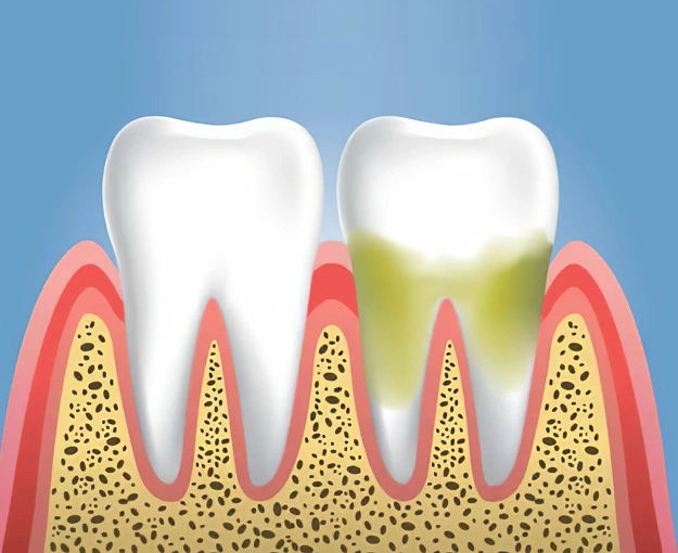 gum disease treatment 