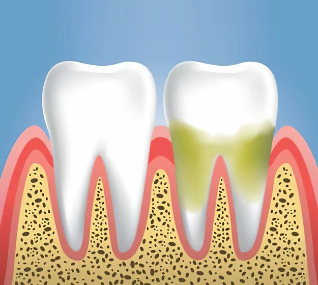 Gum Disease Treatment Houston-Louetta