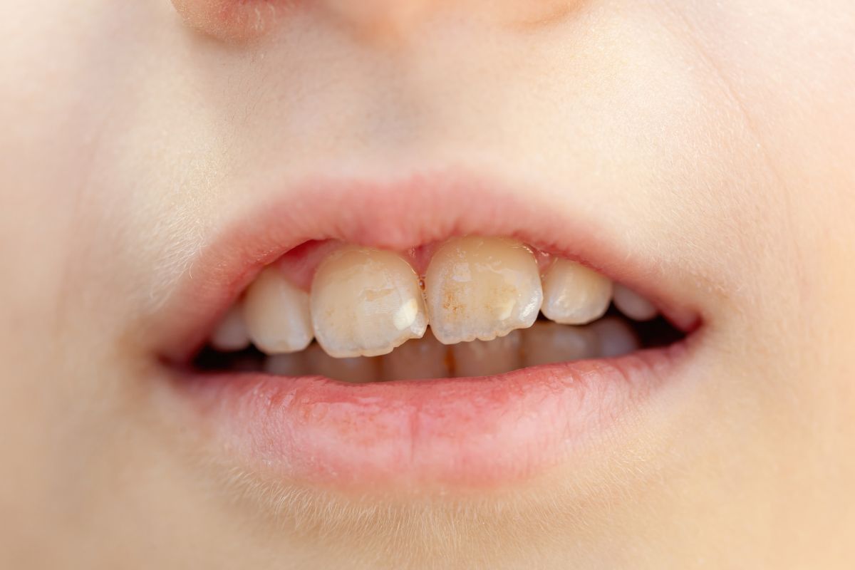 White Spots on Teeth